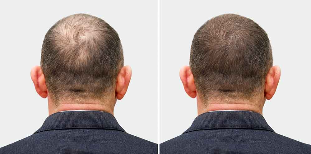 Fut Hair Transplant