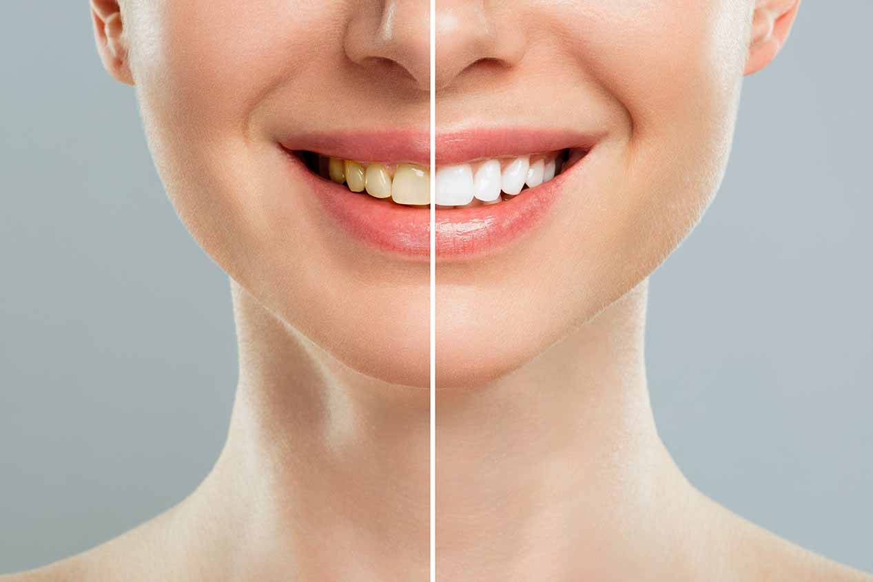 Teeth Whitening