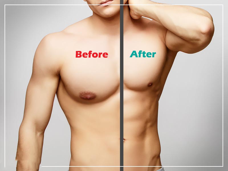Gynecomastia