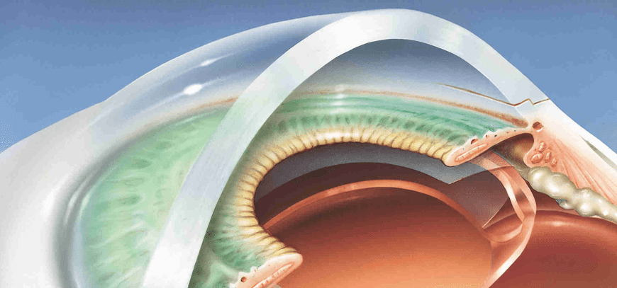 Phako+lOL Lens Implantation
