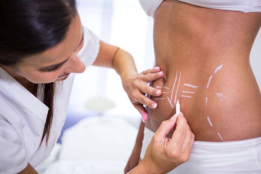 Tummy Tuck