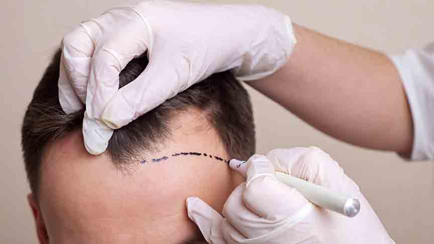 Sapphire Hair Transplant