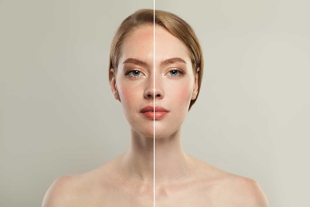 Facial Rejuvenation