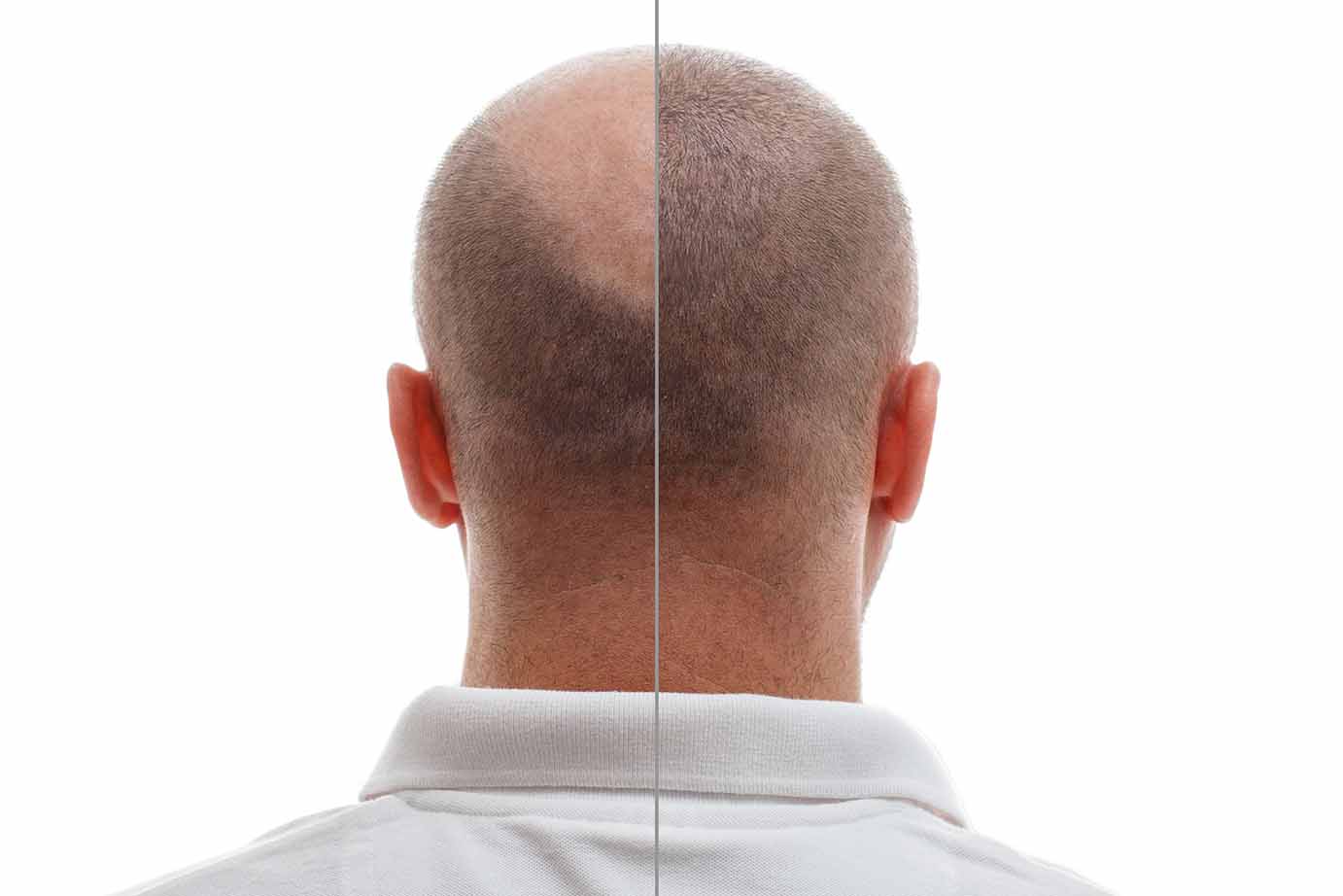 HAIR TRANSPLANT